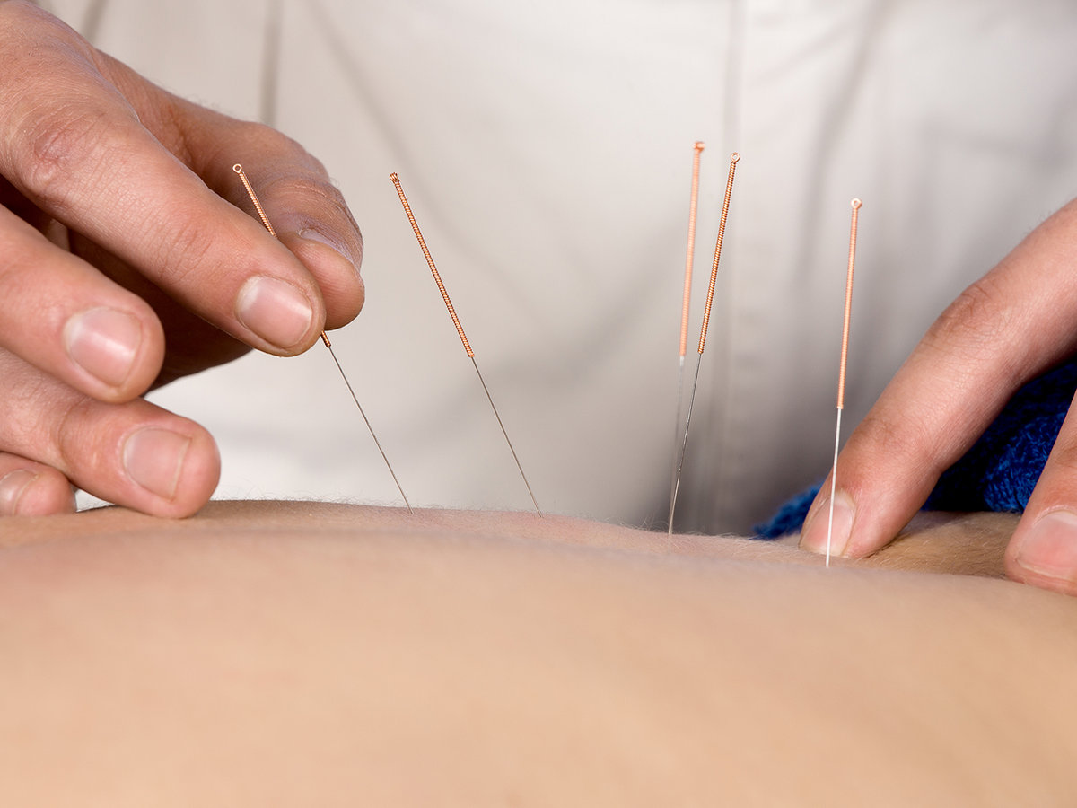 Acupuncture treatment at Five Elements Care